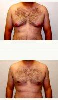Dr Jay M. Pensler, MD, Chicago Plastic Surgeon - 18-24 Year Old Man Treated With Male Breast Reduction