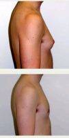 Dr Jay M. Pensler, MD, Chicago Plastic Surgeon 20 Year Old Woman Treated With Male Breast Reduction