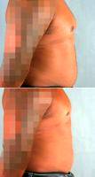 Dr John Mesa, MD, New York Plastic Surgeon 33 Year Old Man Treated With Male Breast Reduction With Enlarged Breasts Due To Bodybuilding