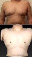 Dr John P. Stratis, MD, Harrisburg Plastic Surgeon Male Breast Reduction With SAFE Liposuction Before
