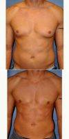 Dr Jonathan Weiler, MD, Baton Rouge Plastic Surgeon Male Breast Reduction (1)