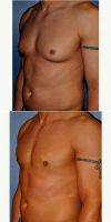 Dr Jonathan Weiler, MD, Baton Rouge Plastic Surgeon Male Breast Reduction (2)