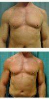 Dr Jonathan Weiler, MD, Baton Rouge Plastic Surgeon Male Breast Reduction (4)