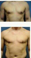 Dr Jonathan Weiler, MD, Baton Rouge Plastic Surgeon Male Breast Reduction (5)