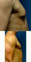Dr Jonathan Weiler, MD, Baton Rouge Plastic Surgeon Male Breast Reduction (6)