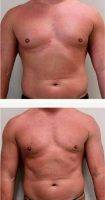 Dr Jonathan Weiler, MD, Baton Rouge Plastic Surgeon Male Breast Reduction (7)