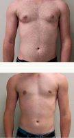 Dr Jonathan Weiler, MD, Baton Rouge Plastic Surgeon Male Breast Reduction (9)