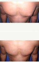 Dr Karol A. Gutowski, MD, FACS, Chicago Plastic Surgeon - 25-34 Year Old Man Treated With Left Male Breast Reduction (Gynecomastia)