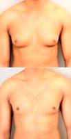 Dr Keshav Magge, MD, Bethesda Plastic Surgeon 27 Year Old Man Treated With Male Breast Reduction