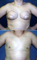Dr Laura A. Sudarsky, MD, Fort Lauderdale Plastic Surgeon 18 Yo Male For Gynecomastia, Male Breast Reduction