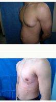 Dr Luis A. Mejia, MD, Dominican Republic Plastic Surgeon 25-34 Year Old Man Treated With Male Breast Reduction
