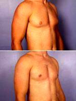 Dr Luis H. Macias, MD, FACS, Los Angeles Plastic Surgeon Male Breast Tissue Removal
