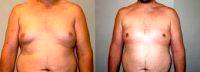 Dr Martin Jugenburg, MD, Toronto Plastic Surgeon Male Chest Liposuction