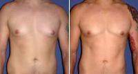 Dr Max Polo, MD, Miami Plastic Surgeon Gynecomastia Male Breast Reduction