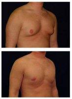 Dr Michael Law, MD, Raleigh-Durham Plastic Surgeon Gynecomastia (Male Breast Reduction)