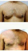 Dr Milan Doshi, MS, MCh, India Plastic Surgeon 31 Year Old Man Treated With Male Breast Reduction 37