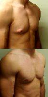 Dr Omar Fouda Neel, MD, FRCSC, FACS, Montreal Plastic Surgeon Male Breast Reduction (1)