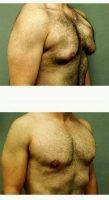 Dr Omar Fouda Neel, MD, FRCSC, FACS, Montreal Plastic Surgeon Male Breast Reduction (3)