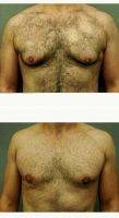 Dr Omar Fouda Neel, MD, FRCSC, FACS, Montreal Plastic Surgeon Male Breast Reduction (6)