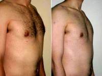 Dr Otto Joseph Placik, MD, Chicago Plastic Surgeon Male Breast Reduction