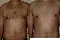 Dr Otto Joseph Placik, MD, Chicago Plastic Surgeon Male Breast Reduction