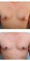 Dr Paul Vitenas, Jr., MD, Houston Plastic Surgeon 18-24 Year Old Man Treated With Male Breast Reduction