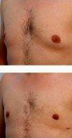 Dr Paul Vitenas, Jr., MD, Houston Plastic Surgeon 33 Year Old Man Treated With Male Breast Reduction