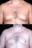 Dr Richard Silverman, MD, Newton Plastic Surgeon Male Breast Reduction