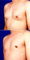 Dr Robert Caridi, MD, Austin Plastic Surgeon 18-24 Year Old Man Treated With Gynecomastis Surgery - Male Breast Reduction