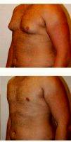 Dr Robert Kratschmer, MD, Houston Plastic Surgeon 18-24 Year Old Man Treated With Male Breast Reduction