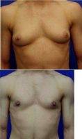 Dr Robert Stroup, Jr., MD, FACS, Cleveland Plastic Surgeon Male Breast Reduction