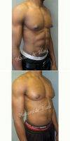 Dr Ron Hazani, MD, FACS, Beverly Hills General Surgeon 41 Year Old Man Treated With Male Breast Reduction