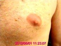 Dr Ronald Friedman, MD, Plano Plastic Surgeon - Male Nipple Reduction (1)