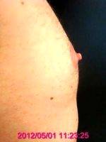 Dr Ronald Friedman, MD, Plano Plastic Surgeon - Male Nipple Reduction (2)