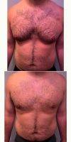Dr S. Larry Schlesinger, MD, FACS, Honolulu Plastic Surgeon 25-34 Year Old Man Treated With Male Breast Reduction