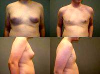 Dr Scott W. Vann, MD, FACS, Savannah Plastic Surgeon - Male Breast Reduction