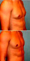 Dr Sean T. Lille, MD, Scottsdale Plastic Surgeon Male Breast Reduction