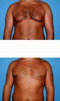 Dr Shayne Webb, MD, Nashville Plastic Surgeon 23 Year Old Man Treated With Male Breast Reduction