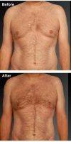 Dr Steven Teitelbaum, MD, Los Angeles Plastic Surgeon Male Breast Reduction