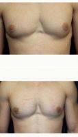 Dr Steven Turkeltaub, MD, Scottsdale Plastic Surgeon 22 Year Old Male With Gynecomastia Treated With Direct Excision Of Breast Tissue Only