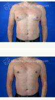 Dr Tal T. Roudner, MD, FACS, Miami Plastic Surgeon Dr Tal's Minimally Invasive Male Breast Reduction