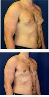 Dr Theodore Nyame, MD, Charlotte Physician 25-34 Year Old Man Treated With Male Breast Reduction
