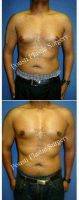 Dr Tom J. Pousti, MD, FACS, San Diego Plastic Surgeon 34 Year Old Man Treated With Male Breast Reduction