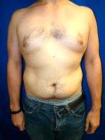 Dr Tom J. Pousti, MD, FACS, San Diego Plastic Surgeon Gynecomastia, Liposuction For Men (1)
