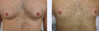 Dr. Adrian Richards, MBBS, MSc, FRCS (Plast), London Plastic Surgeon - 46 Year Old Male Nipple Reduction Patient