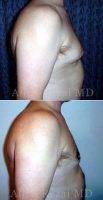 Dr. Allen Rezai, MD, London Plastic Surgeon 35-44 Year Old Man Treated With Male Breast Reduction