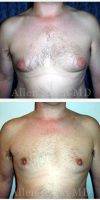 Dr. Allen Rezai, MD, London Plastic Surgeon - Before And After Male Breast Reduction Surgery (1)