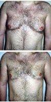 Dr. Allen Rezai, MD, London Plastic Surgeon - Before And After Male Breast Reduction Surgery (2)