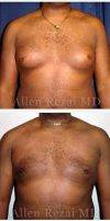 Dr. Allen Rezai, MD, London Plastic Surgeon - Before And After Male Breast Reduction Surgery (4)
