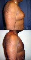 Dr. Allen Rezai, MD, London Plastic Surgeon - Before And After Male Breast Reduction Surgery (5)